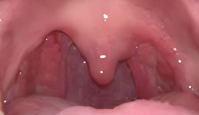 The Mystery of Tonsil Regrowth